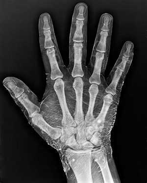 X-Ray of a hand